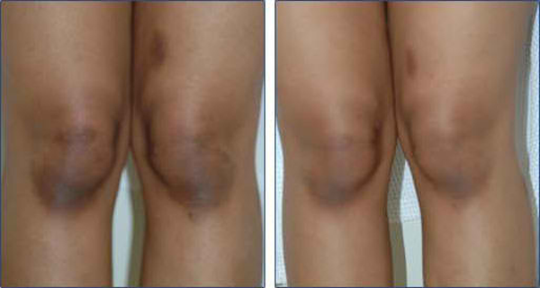Les salles de bain pour les enfants atopitchesky la dermatite